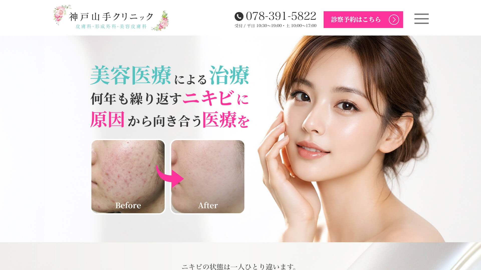 美容皮膚科クリニックのニキビ治療のLPの制作実績