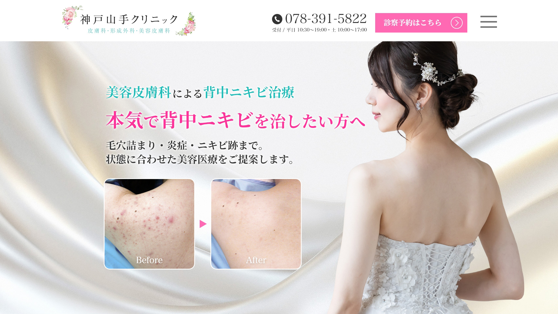 背中ニキビ治療の美容皮膚科クリニックのLPの制作実績